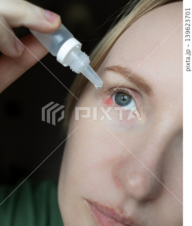 Close-up of a woman applying medical drops to treat a red eye stye or chalazion on the lower eyelid. Healthcare, ophthalmology and infection treatment concept. Close-up of a woman applying medical drops to treat a red eye stye or chalazion on the lower eyelid. Healthcare, ophthalmology and infection treatment concept. 139623701