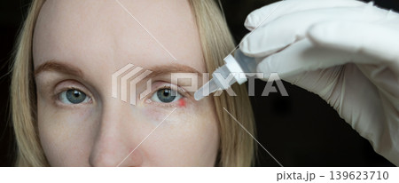 Close-up of a woman applying medical drops to treat a red eye stye or chalazion on the lower eyelid. Healthcare, ophthalmology and infection treatment concept. Close-up of a woman applying medical drops to treat a red eye stye or chalazion on the lower eyelid. Healthcare, ophthalmology and infection treatment concept. 139623710