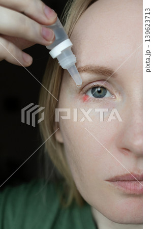 Close-up of a woman applying medical drops to treat a red eye stye or chalazion on the lower eyelid. Healthcare, ophthalmology and infection treatment concept. Close-up of a woman applying medical drops to treat a red eye stye or chalazion on the lower eyelid. Healthcare, ophthalmology and infection treatment concept. 139623713