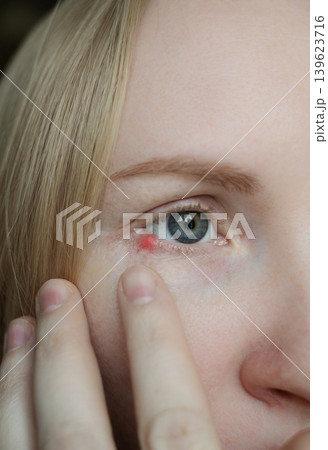 Close-up of a woman applying medical drops to treat a red eye stye or chalazion on the lower eyelid. Healthcare, ophthalmology and infection treatment concept. Close-up of a woman applying medical drops to treat a red eye stye or chalazion on the lower eyelid. Healthcare, ophthalmology and infection treatment concept. 139623716