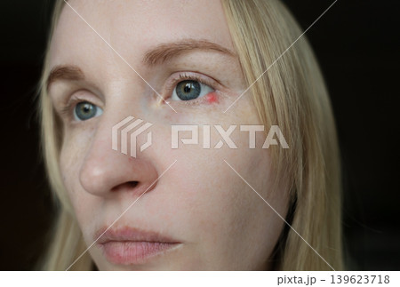 Close-up of a woman applying medical drops to treat a red eye stye or chalazion on the lower eyelid. Healthcare, ophthalmology and infection treatment concept. 139623718