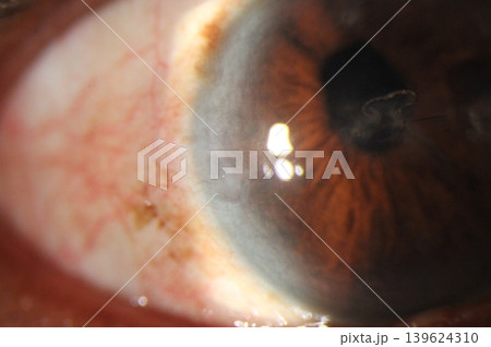 Anterior segment close-up demonstrating corneal arcus (gerontoxon) with a visible corneal suture. 139624310