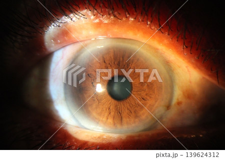 Arcus lipoides during slit-lamp examination 139624312