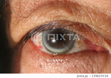 Arcus senilis visualized on slit lamp examination of the cornea 139624316