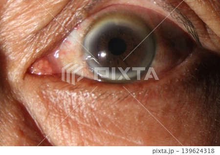 Clinical slit lamp view of arcus senilis presenting as a gray-white ring at the corneal periphery 139624318
