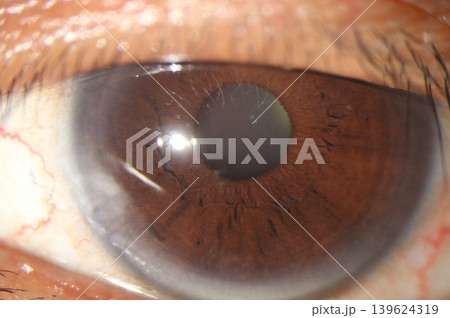 Close up of arcus senilis 139624319
