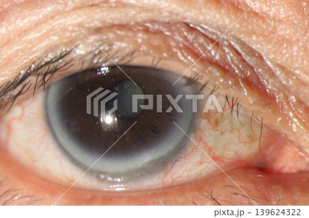 Close-up image of arcus senilis partially obscured by the upper eyelid 139624322