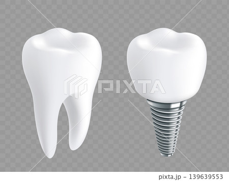 Dental implant and healthy human tooth Dental implant and healthy human tooth 139639553