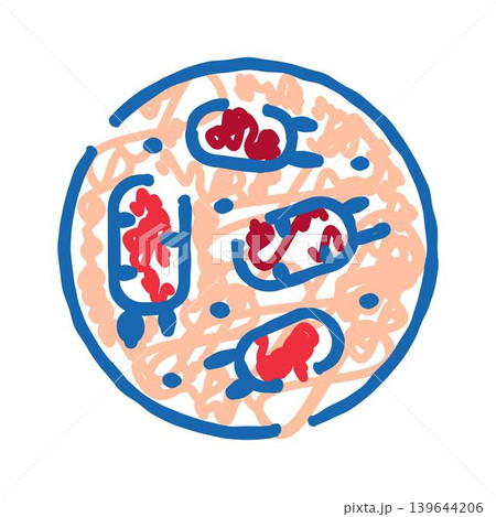 Blood clot forming in human artery causing thrombosis 139644206