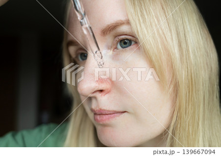 Close-up of woman applying serum with pipette on face with couperose and rosacea symptoms on nose. Professional skincare treatment for dilated capillaries and redness. Close-up of woman applying serum with pipette on face with couperose and rosacea symptoms on nose. Professional skincare treatment for dilated capillaries and redness. 139667094