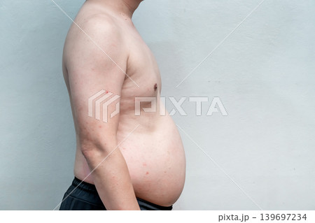 The symptom of Dengue fever on skin of a man 39 years old, the detail of red spots and rash on the skin of a man in the recovery phase. 139697234