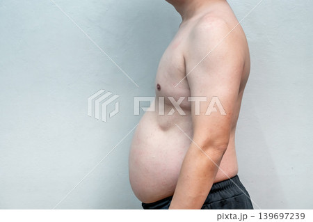 skin rash and red spots on body of adult man during dengue fever infection and recovery period in Dec 2022. 139697239