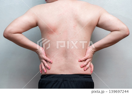 skin rash and red spots on body of adult man during dengue fever infection and recovery period in Dec 2022. 139697244