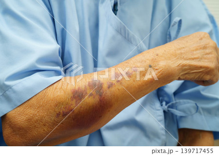 Ecchymosis, elderly bleeding on her arm after taking aspirin. 139717455