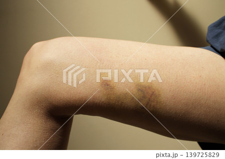 bruise bruise 139725829
