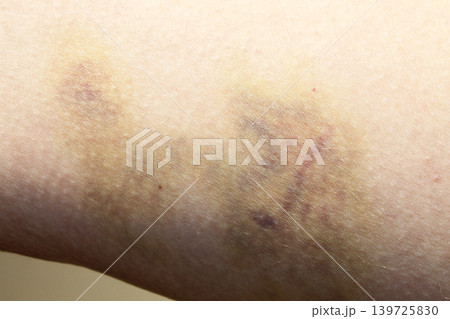 bruise 139725830