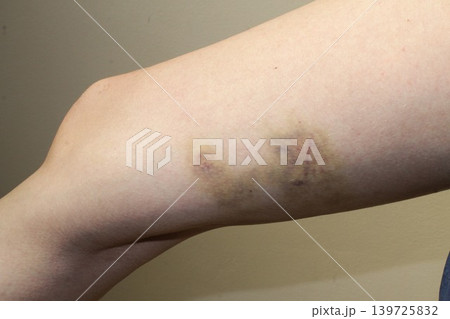 bruise 139725832