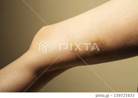 bruise 139725833