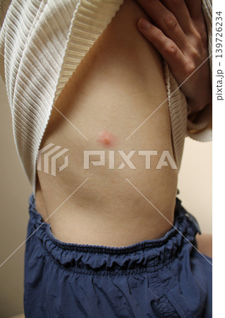 insect bite 139726234
