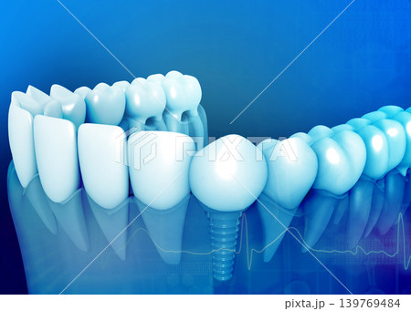 Tooth anatomy with dental implant 139769484