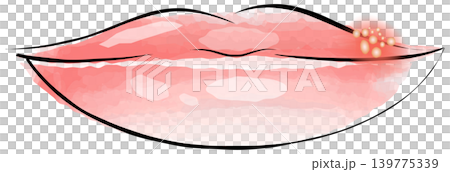 cold sore 139775339