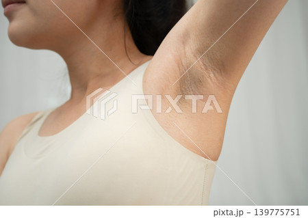Asian woman have problem black armpit beauty skin care. Asian woman have problem black armpit beauty skin care. 139775751
