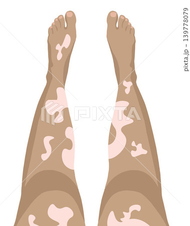 Vector isolated illustration of chronic disease vitiligo. 139778079