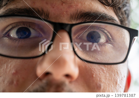 Young man wearing black rimmed glasses and looking directly into the camera, showing a wide eyed gaze and detailed facial features with visible pores and slight acne Young man wearing black rimmed glasses and looking directly into the camera, showing a wide eyed gaze and detailed facial features with visible pores and slight acne 139781387