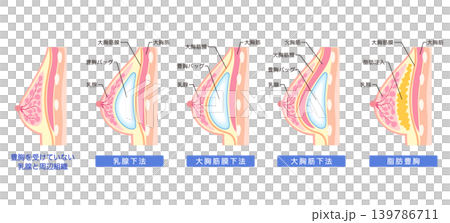 隆乳手術的類型和結構 隆乳手術的類型和結構 139786711