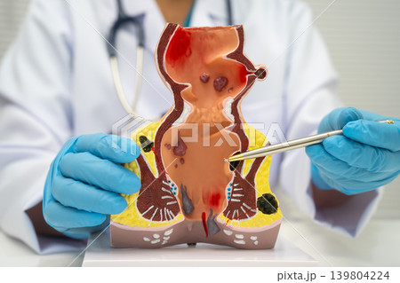 Asian doctor with rectum and hemorrhoid human model, inflamed vascular structure. 139804224