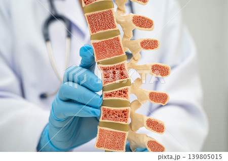 Doctor holding osteoporosis in back bone model for treatment medical in orthopedic department. Doctor holding osteoporosis in back bone model for treatment medical in orthopedic department. 139805015
