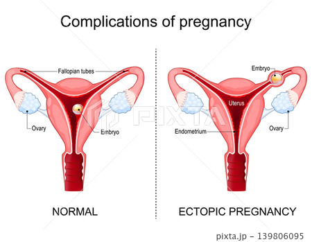 Ectopic pregnancy. Complications of pregnancy Ectopic pregnancy. Complications of pregnancy 139806095