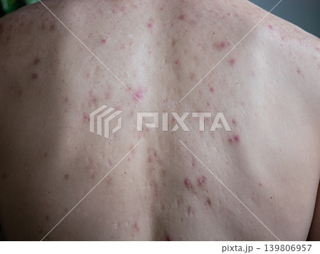 Man back with acne marks and pimples. Close up skin with blemishes. Health concept for dermatology, beauty, and treatment of skin problem. Man back with acne marks and pimples. Close up skin with blemishes. Health concept for dermatology, beauty, and treatment of skin problem. 139806957