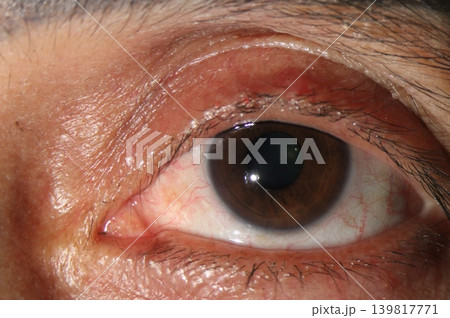 Inflamed upper eyelid (blepharitis) with hyperemia, edema, and multiple black debris along the eyelid margin Inflamed upper eyelid (blepharitis) with hyperemia, edema, and multiple black debris along the eyelid margin 139817771