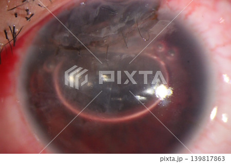 Intracameral air bubble within the anterior chamber with a sutured corneal laceration. 139817863