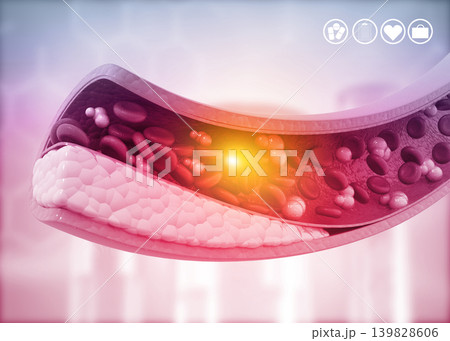 Atherosclerosis, Cholesterol plaque in artery 139828606