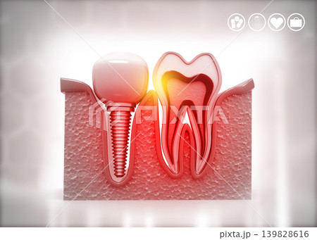 Tooth implant, Dental concept Tooth implant, Dental concept 139828616