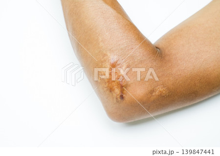 Keloid scar on elbow skin of patient after injury. Hypertrophic tissue growth during healing process requiring laser and surgery treatment. Abnormal tissue healing requiring laser removal treatment. Keloid scar on elbow skin of patient after injury. Hypertrophic tissue growth during healing process requiring laser and surgery treatment. Abnormal tissue healing requiring laser removal treatment. 139847441