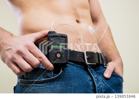 Diabetic man with an insulin pump connected in his abdomen Diabetic man with an insulin pump connected in his abdomen 139853846