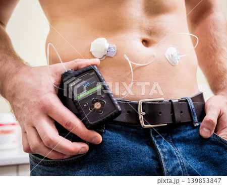Diabetic man with an insulin pump connected in his abdomen Diabetic man with an insulin pump connected in his abdomen 139853847