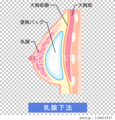 矽膠假體隆乳:隆乳手術結構(腺體下植入法) 矽膠假體隆乳:隆乳手術結構(腺體下植入法) 139854937