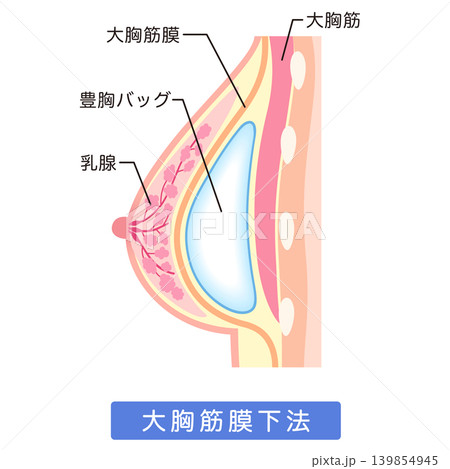 シリコンバッグを入れた胸　豊胸手術の構造　大胸筋膜下法 139854945