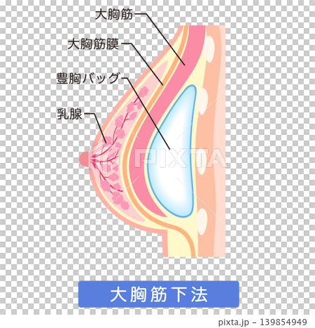 矽膠假體隆乳:隆乳手術結構,肌肉下植入法。 矽膠假體隆乳:隆乳手術結構,肌肉下植入法。 139854949