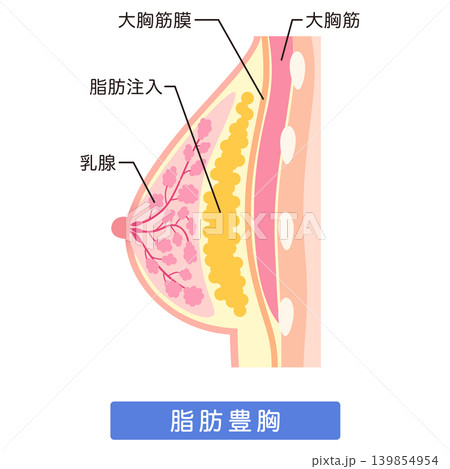 脂肪注入をした胸　豊胸手術の構造　脂肪豊胸 139854954