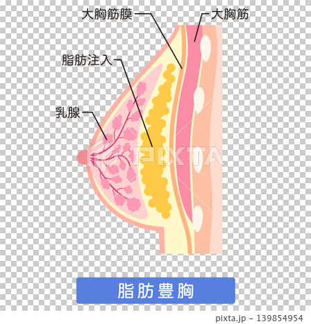 自體脂肪隆乳;隆乳手術結構;自體脂肪隆乳。 自體脂肪隆乳;隆乳手術結構;自體脂肪隆乳。 139854954