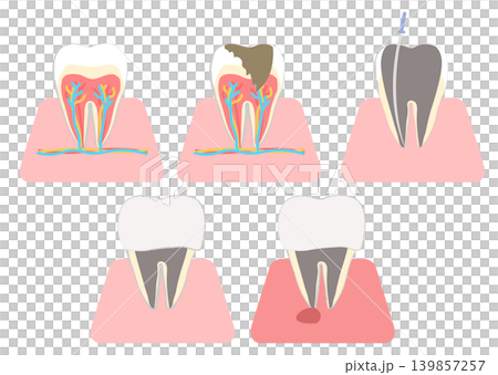 Illustration of the internal structure of a molar: Root canal treatment, abscess Illustration of the internal structure of a molar: Root canal treatment, abscess 139857257