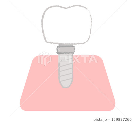 歯科治療のインプラントのイラスト 139857260