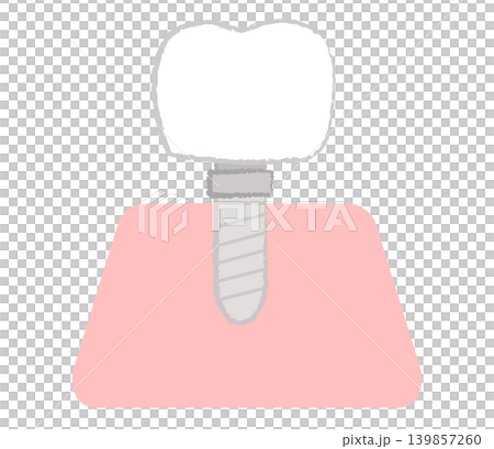 歯科治療のインプラントのイラスト 139857260