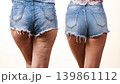 Comparison of legs with and without cellulite 139861112