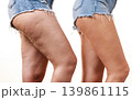 Comparison of legs with and without cellulite 139861115